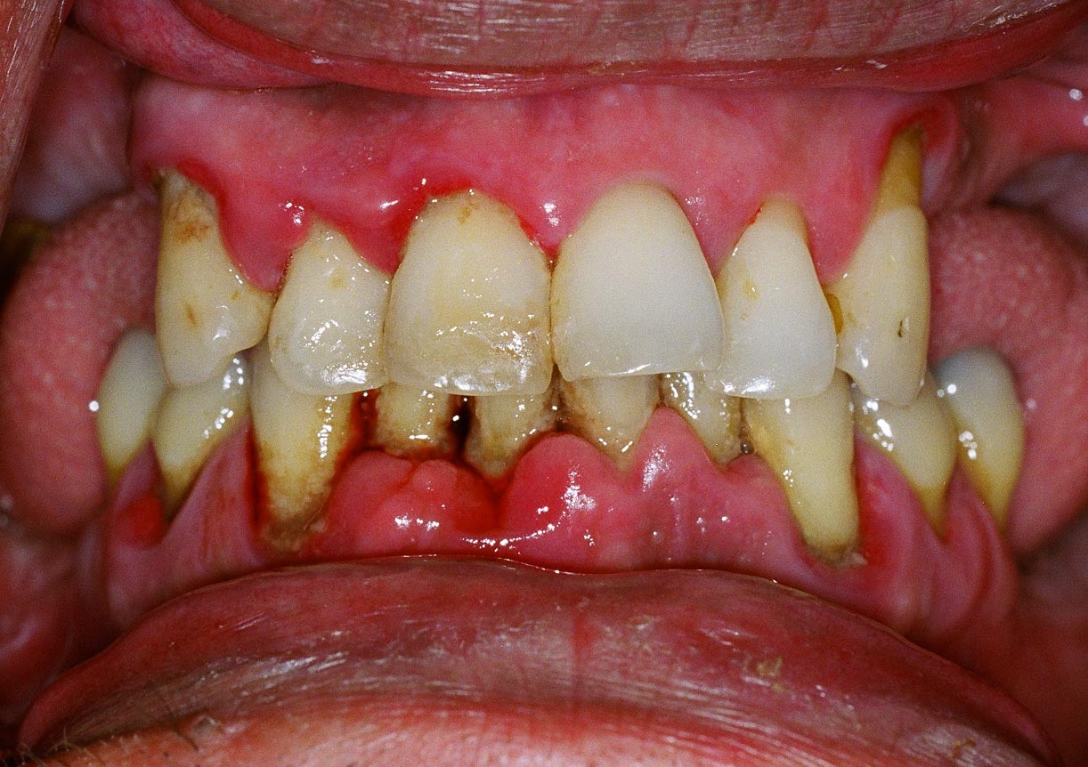 Early Signs From Gingivitis To Periodontal Treatment Precious Smile